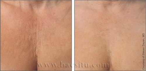 Căng da vùng ngực trên bằng công nghệ Ultherapy