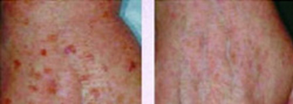 Xóa đốm nâu (Brown Pigmentation)