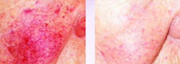Trị trứng cá đỏ (Rosacea)