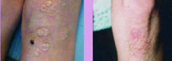 Xóa mụn cóc (Warts)