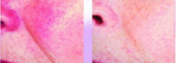 Trị đỏ da (Redness)