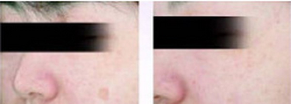 Xóa đốm nâu (Brown Pigmentation)