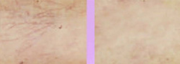Xóa gân máu chân (Leg Veins)