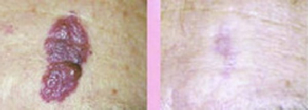 Trị u máu (Hemangioma)