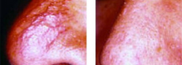 Xóa gân máu ở mũi (Nose Veins)