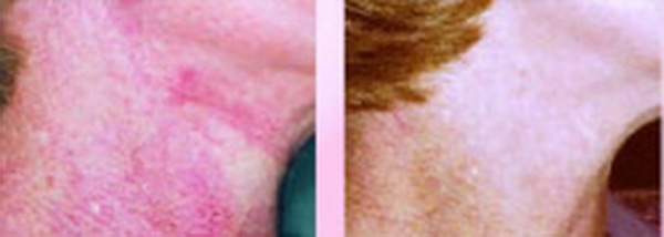 Trị chứng “da lốm đốm” Civatte (Poikiloderma of Civatte)