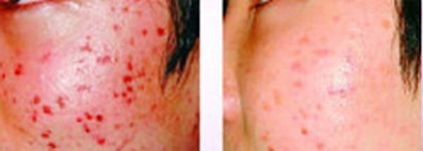 Xóa đỏ da do mụn (Acne Redness)