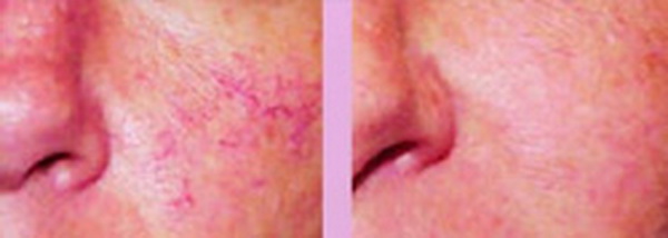 Trị trứng cá đỏ (Rosacea)