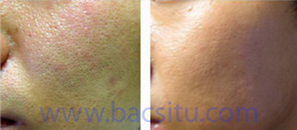 Se lỗ chân lông bằng các công nghệ thẩm mỹ