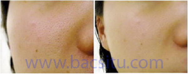 Se lỗ chân lông bằng các công nghệ thẩm mỹ