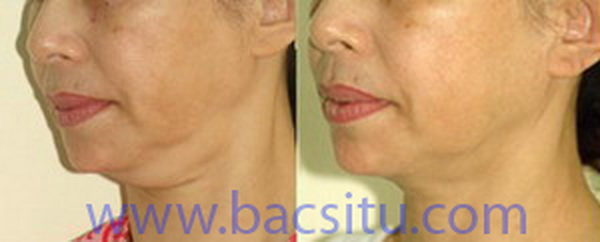 Thon gọn nọng và cạnh hàm
