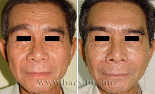 Trẻ hóa khuôn mặt 
