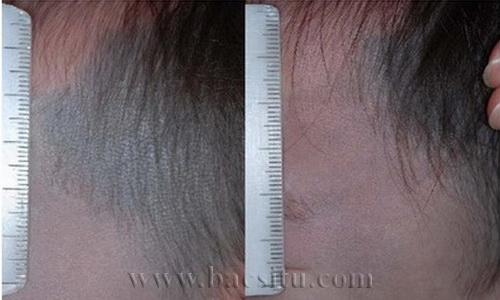 Xóa bớt ota bằng Laser PicoSure