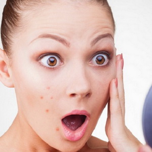 Điều trị mụn và sẹo đỏ sau mụn
