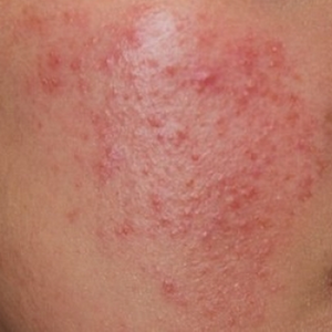 Viêm da do mỹ phẩm chứa corticoid là gì?