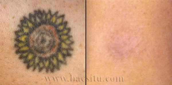 Xóa màu xăm khó bằng Laser PicoSure