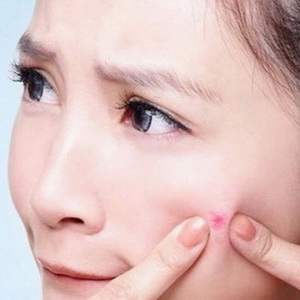 Mùa hè -  mùa dễ nổi mụn