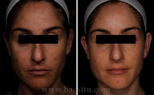 Điều trị sáng da và xóa đồi mồi bằng Laser Pico