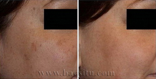 Trẻ hóa da bằng Laser Pico