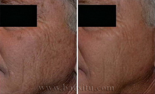 Trẻ hóa da bằng Laser Pico