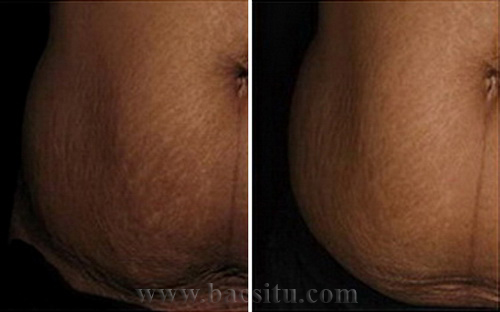 Săn da bằng Laser Pico