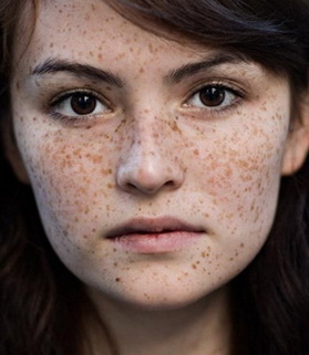 Điều trị tàn nhang bằng Laser