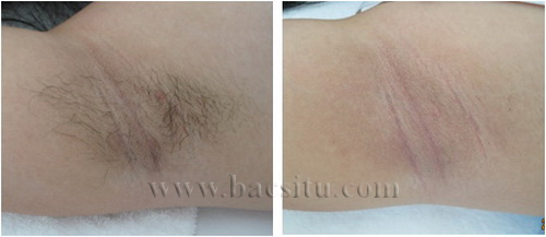 Triệt lông vùng nách