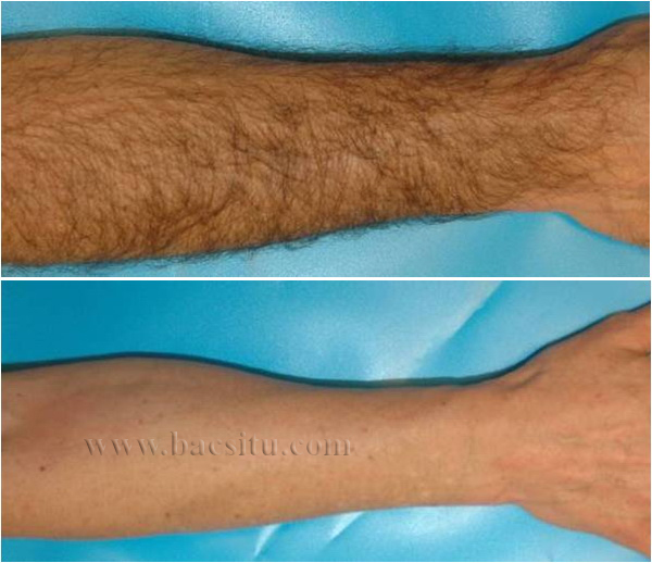 Triệt lông vùng cánh tay