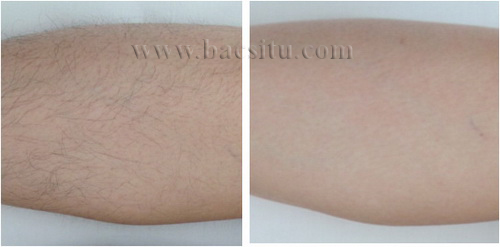 Triệt lông vùng chân