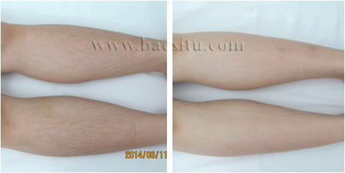 Triệt lông vùng chân