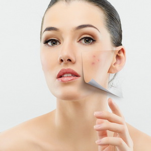 Trị mụn và xóa sẹo mụn bằng các công nghệ mới
