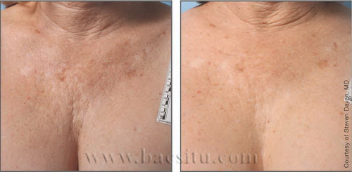 Căng da vùng ngực trên bằng công nghệ Ultherapy