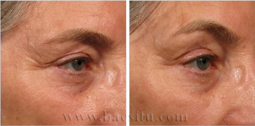 Nâng chân mày bằng công nghệ Ultherapy