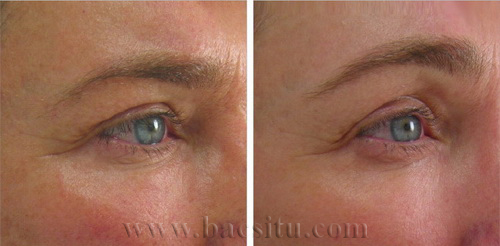 Nâng chân mày bằng công nghệ Ultherapy