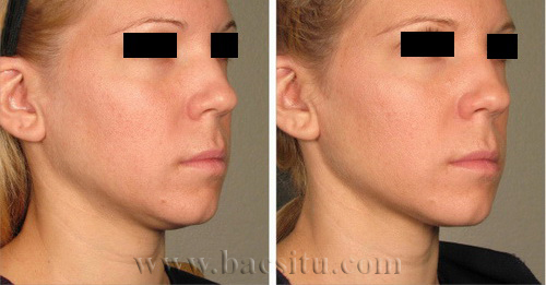Căng da mặt bằng công nghệ Ultherapy