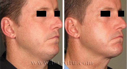 Căng da mặt bằng công nghệ Ultherapy