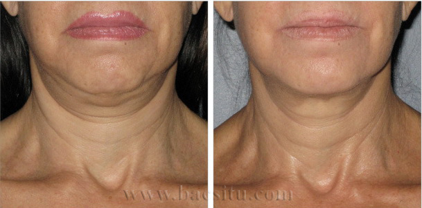 Căng da vùng cổ bằng công nghệ Ultherapy