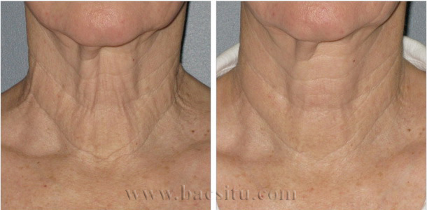 Căng da vùng cổ bằng công nghệ Ultherapy