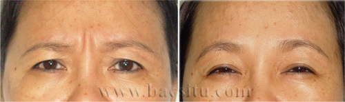 Xóa nhăn cau mày bằng BOTOX