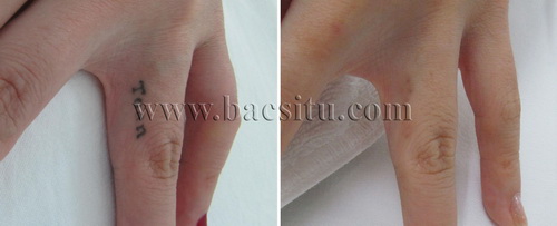 Xóa xăm bằng Laser PicoSure