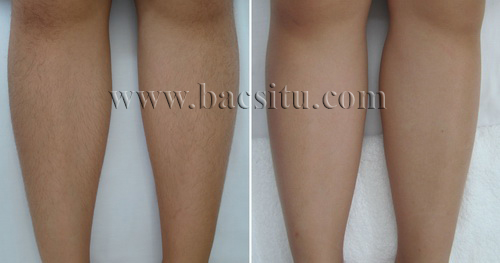 Triệt lông vùng chân