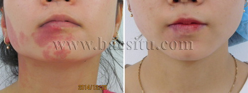Xóa bớt đỏ bằng Laser