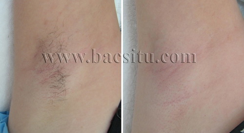 Triệt lông vùng nách