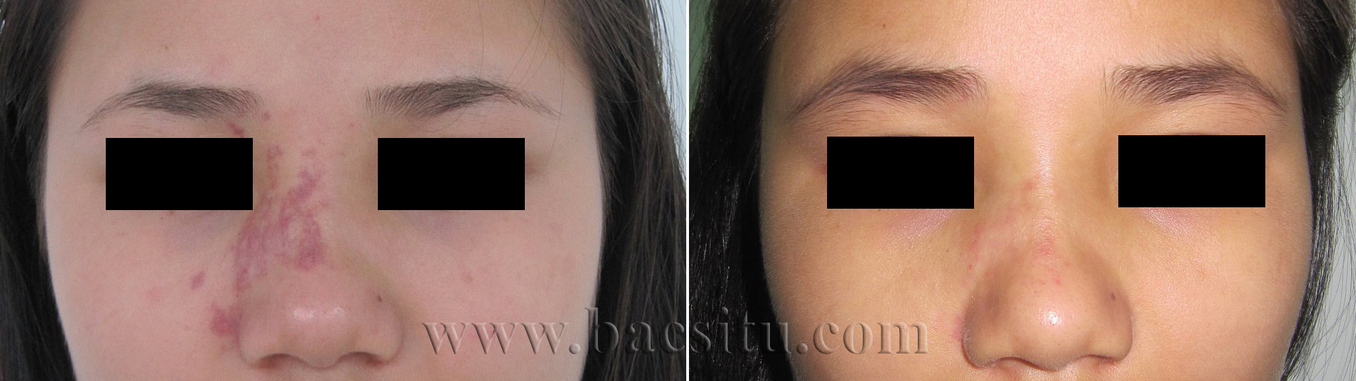 Xóa bớt đỏ bằng Laser