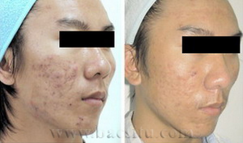 Xóa sẹo mụn