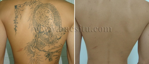 Xóa xăm bằng Laser PicoSure