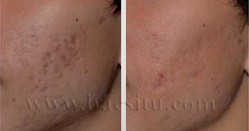Xóa sẹo mụn