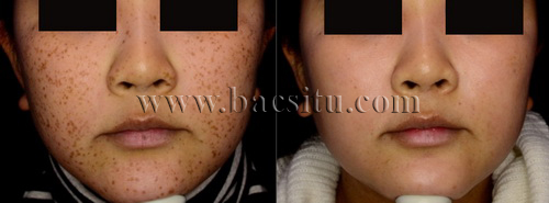 Xóa tàn nhang bằng Laser