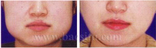 Thon gọn cạnh hàm bằng Botox