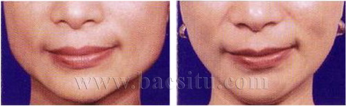 Thon gọn cạnh hàm bằng Botox